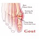 Appearances of gout