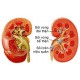 Cure for kidney stones
