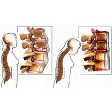 Effects of glucosamine